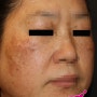 타병원 레이저치료후 과색소침착 초래된 후천성 오타모반(오타양모반) 치료 01