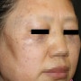 타병원 레이저치료후 과색소침착 부작용을 초래한 후천성 오타모반(오타양모반) 치료 02
