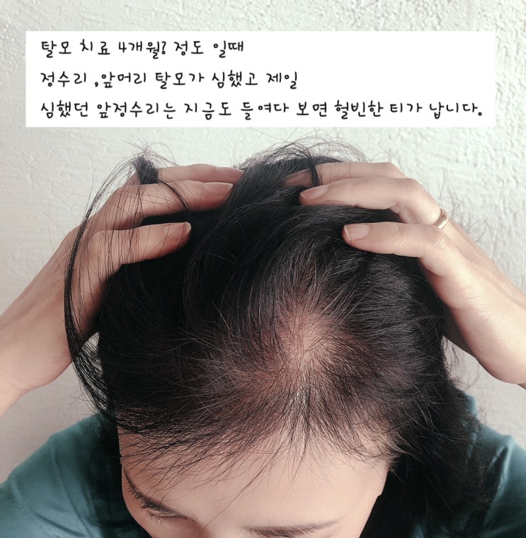 숱이 적은 여성을 위한 제품
