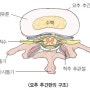 허리디스크 (요추 추간판 탈출증)