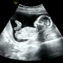 [임신 일기] 16주 - 2차 기형아 검사&성별