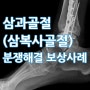 삼과골절(삼복사골절)수술 후유장해 보상 사례
