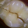 < 치아 균열 > 2. 치료가 필요 없는 균열 vs 치료가 필요한 균열
