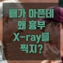 배가 아픈데 왜 흉부 X-ray를 찍지?(급성심근경색, 폐렴일수도 고혈압, 당뇨, 흡연환자 조심)보험가입필수!