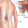 허리디스크 치료의 최선