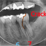 < 치아균열 > 3. 균열 치아의 치료 증례 - 선릉역치과 -