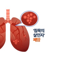 ‘우리나라 암사망률 1위= 폐암’…조기 진단 중요!