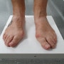 무지외반증으로 인한 발바닥통증 발목통증 개선