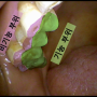 <치아파절> 5. 치료가 필요 없는 파절 vs 치료가 필요한 파절