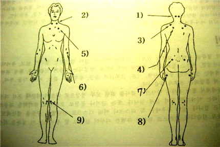 [재활] 근육류마티즘(Muscular Rheumatism) : 네이버 블로그