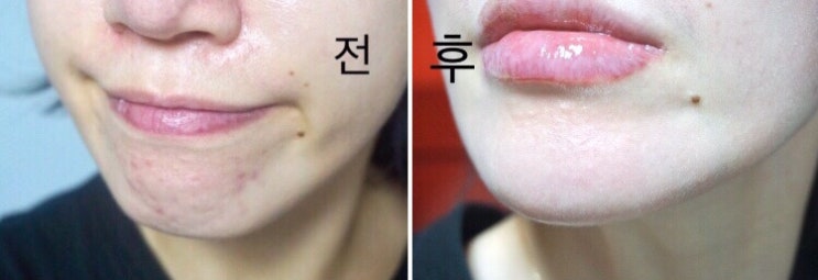 여드름 약 이소티논 1년 복용중 효과 후기(부작용,처방가격,복용량)+최근 업뎃 202203 : 네이버 블로그