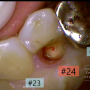 < 치아파절 > 6. 파절 치아의 치료 증례 I. 소량 파절