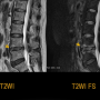 척추염/척추골수염Vertebral Osteomyelitis (VOM) Spondylodiscitis 진단 치료 MRI 소견