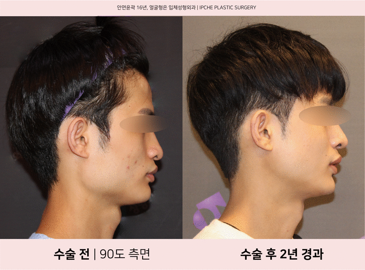 남자사각턱수술비용 샤프한 이미지로! : 네이버 블로그