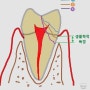 < 치아파절 > 7. 파절 치아의 치료 증례 II. 생물학적 폭경