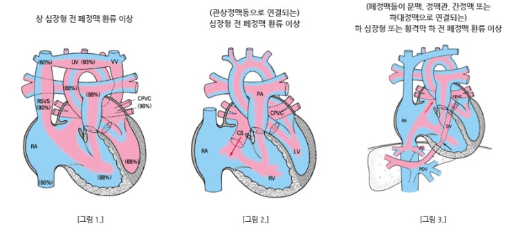 전 폐정맥 환류 이상 [ Total anomalous pulmonary venous return, TAPVR ] : 네이버 블로그