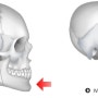 양악수술 케이스 - 3급 부정교합