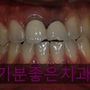 [부천상동치과/부천치과/기분좋은치과/상동역치과/임플란트/앞니치료/앞니성형] 앞니를 예쁘게 하고싶어요.