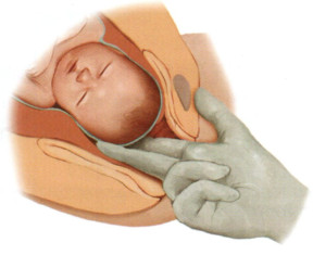 지연임신(prolonged pregnancy), 만기 후 출산(postterm birth) / pos-term infant ...