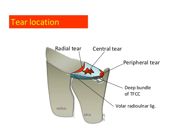 TFCC tear / injury wirst (A/S synovectomy) : 네이버 블로그