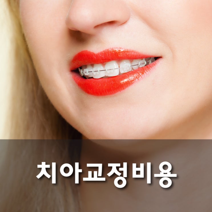 치아교정비용 알려드릴게요. 부정교합 교정 신중하게 해야 해요. : 네이버 블로그