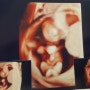 임신 12주차 : 초기정밀초음파