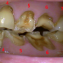 < 치아파절 > 8. 파절 치아의 치료 증례 III. 큰어금니 - 선릉역치과 -