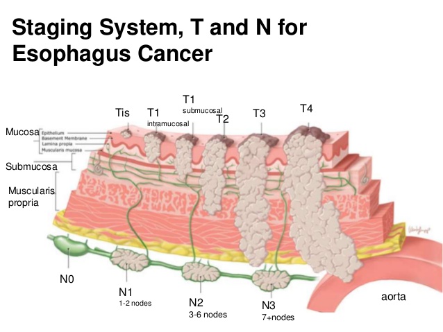 식도암의 병기 Esophageal Cancer Staging System 네이버 블로그