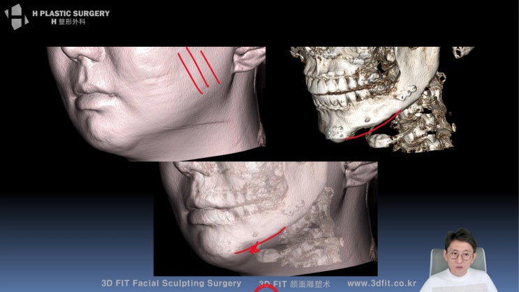 안면윤곽수술 효과못보는 얼굴형이 있다고? : 네이버 블로그