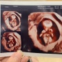임신10주 / 임신12주 초음파 및 기형아검사
