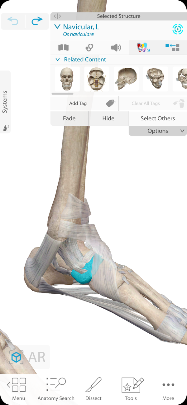 부주상골 증후군 -> 발목 안쪽 복사뼈 있는 데가 아파요 (Accessory Navicular Bone Syndrome ...