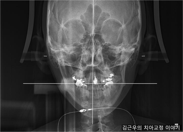 안면 비대칭 치아교정으로 개선할 수 있나요 : 네이버 블로그