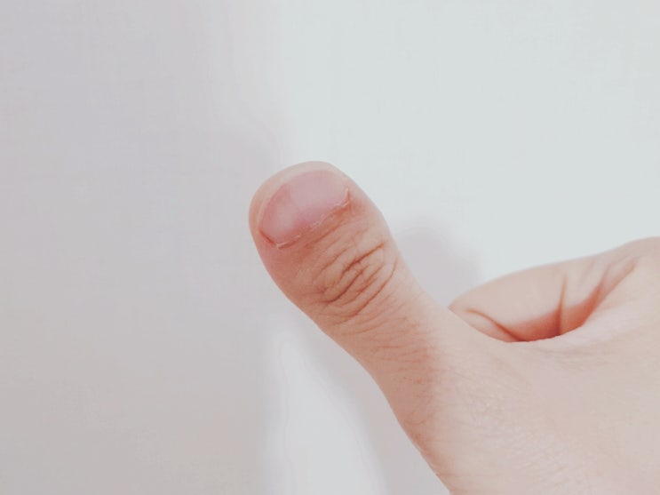엄지손가락 단지증, 엄마랑 무엇이 닮았을까? : 네이버 블로그
