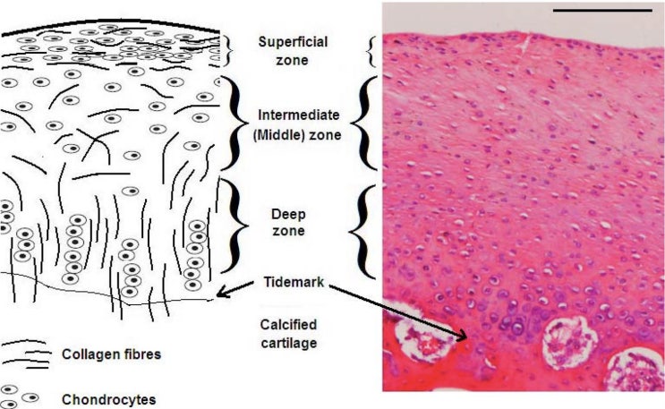 무릎 연골 파열 및 재생 치료 (articular cartilage tear of the knee joint) : 네이버 블로그