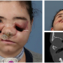 3D Printing and Virtual Surgery Help Repair Damage to Patient’s Face