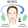 일산보청기 BICROS 기술을 이용한 고도 이상 감각신경성 난청의 청각재활 이해