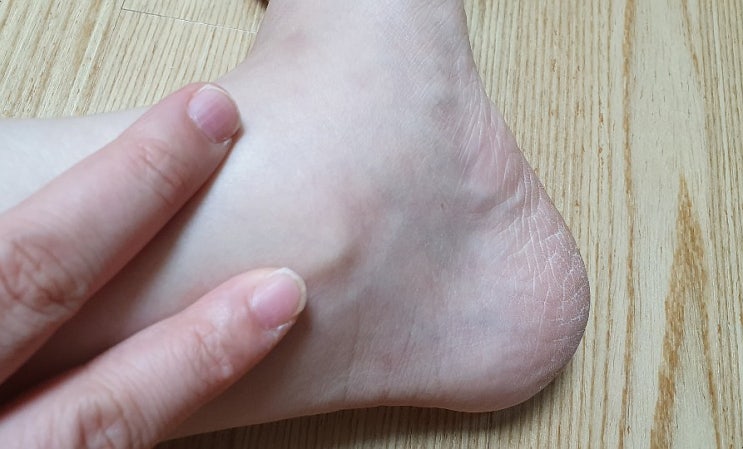 복숭아뼈 물혹 원인과 예방법은 : 네이버 블로그