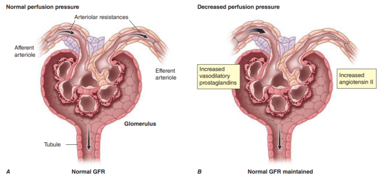 급성 신손상 Acute kidney injury (AKI) - 1. Prerenal azotemia : 네이버 블로그