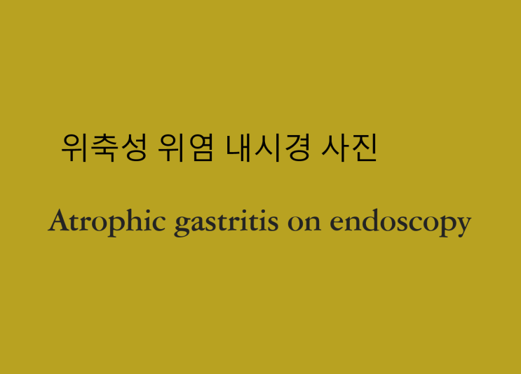 위축성 위염 내시경 사진, Atrophic gastritis on endoscopy : 네이버 블로그