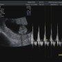 두찌일기 11w6d 수원 시온여성병원 두근두근 1차기형아검사 하는날