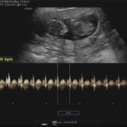 임신기록 12주 4일 1차 기형아 검사