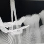 치과위생사 치과 엑스레이(x-ray) 촬영팁. 치근단 촬영