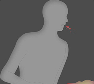 객혈, 객혈증상, 피섞인 가래, 객혈치료 : 네이버 블로그