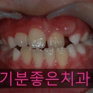 [소아교정/페이스마스크/성장교정/facemask] 성장교정시기