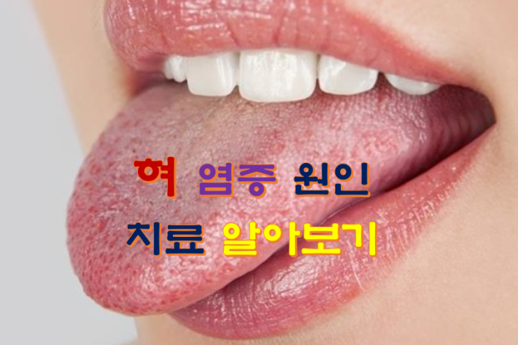 혀 염증 원인 치료 알아보기 : 네이버 블로그