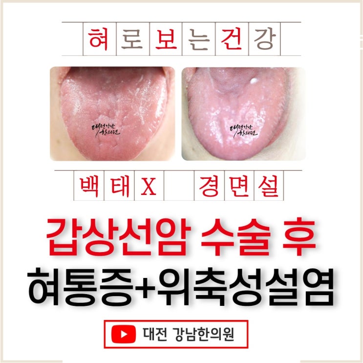 갑상선암 수술 후 입이 마르고 혀가 아파요: 경면설/위축성설염 환자 사례 : 네이버 블로그