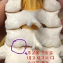 목디스크 수술_경추간판탈출증_후방디스크 제거술_Cervical HNP_Cervical Posterior foraminotomy with discectomy.