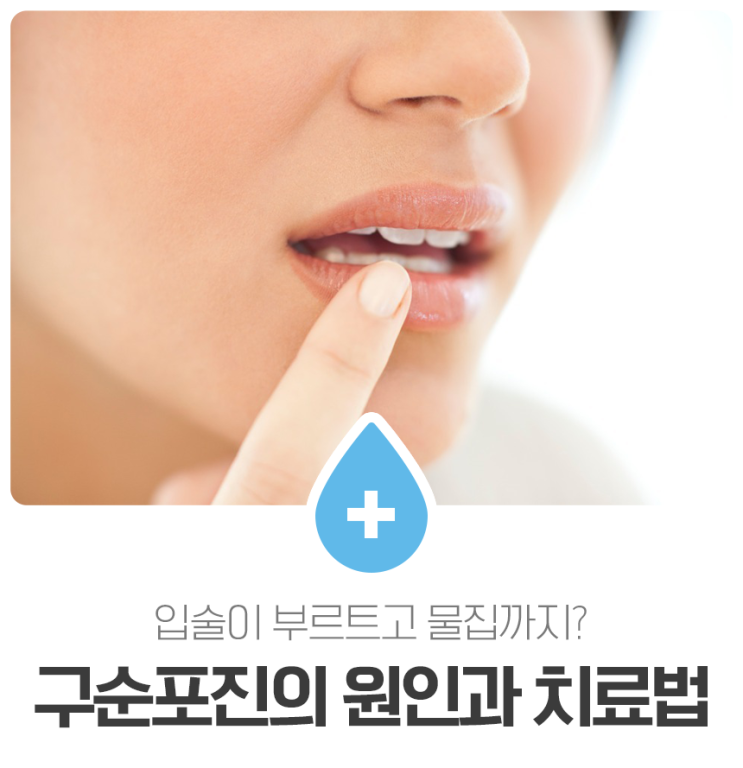 입술이 부르트고 물집까지? 구순포진의 원인과 치료법 : 네이버 블로그