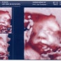[임신기록] 28주1일 8개월 입체초음파 추가 검진