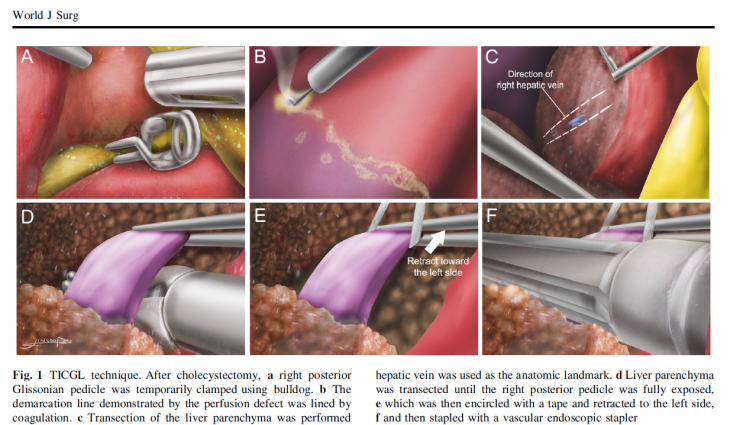 메디컬일러스트 그리닥: 복강경우후구역절제술 수술 술기 일러스트, laparoscopic posterior ...